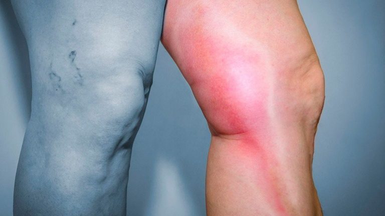 Causas y síntomas de la trombosis venosa profunda
