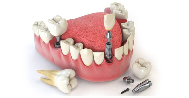 implantes dentales vs puentes